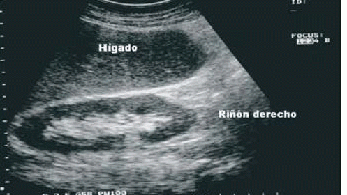 Ecografía renal