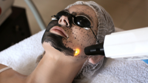 Rejuvenecimiento facial por láser con carbón activo